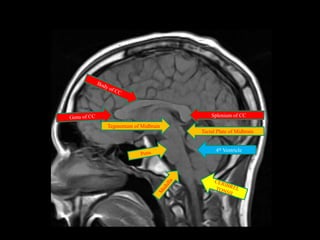 Splenium of CC
Tegmentum of Midbrain
                        Tectal Plate of Midbrain


                              4th Ventricle
 