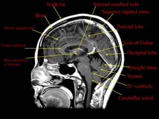 Scalp fat   Internal cerebral vein
                                           Superior sagittal sinus
                      . Bone

 Inferior sagittal sinus                          Parietal lobe


Corpus callosum
                                                     Vein of Galen
                                                       Occipital lobe
 Mass intermedia
 of thalamus
                                                       Straight sinus
                                                      . Vermis
                                                      . IV ventricle

                                                   Cerebellar tonsil
 