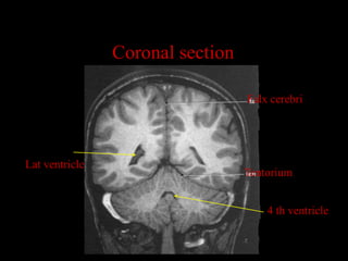 Coronal section

                                  Falx cerebri




Lat ventricle
                                  Tentorium


                                      4 th ventricle
 