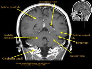 Choroid plexus within
                                                        lateral ventricle
Posterior frontal lobe




   Cerebellar                                                                   . Posterior temporal
   hemisphere                                                                   lobe

                                                                                       Tentorium



                                                                               Superior vermis
 Cerebellar tonsil
                 Coronal Section of the Brain at the level of IV Ventricle
                       Post Contrast Coronal T1 Weighted MRI
 
