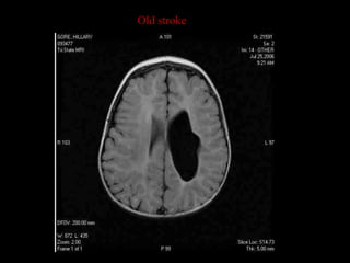 Old stroke
 