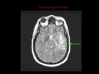 New stroke in T2 flair
 