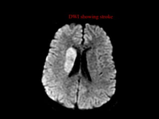 DWI showing stroke
 