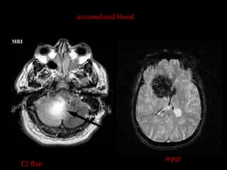 accumulated blood




                               mpgr
T2 flair
 