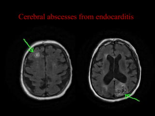 Cerebral abscesses from endocarditis
 