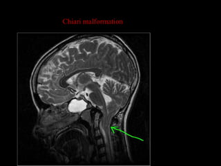 Chiari malformation
 
