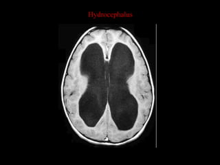 Hydrocephalus
 