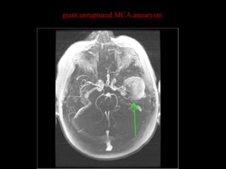 giant unruptured MCA aneurysm
 