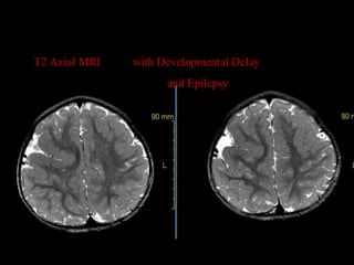 T2 Axial MRI   with Developmental Delay
                     and Epilepsy
 