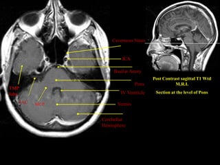 MRI SECTIONAL ANATOMY OF BRAIN 