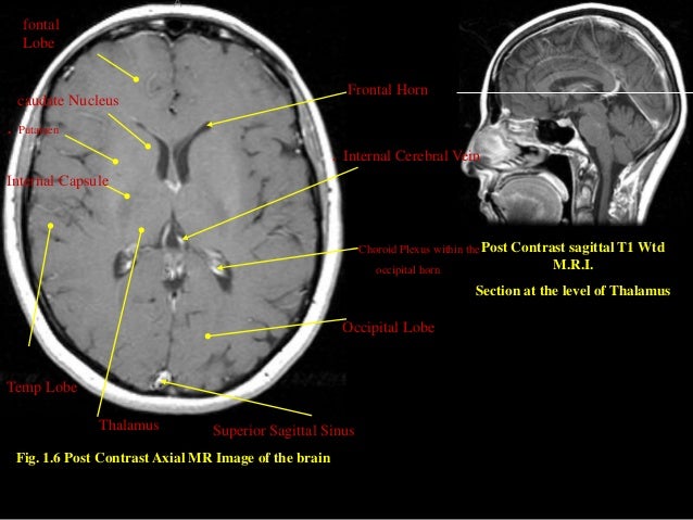 MRI SECTIONAL ANATOMY OF BRAIN