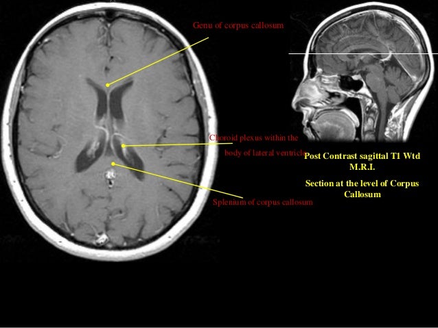 MRI SECTIONAL ANATOMY OF BRAIN