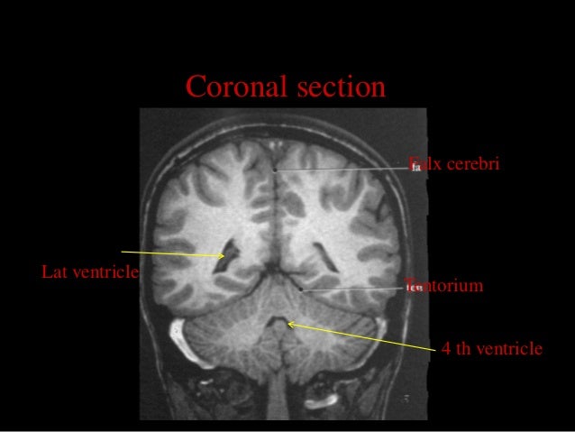 MRI SECTIONAL ANATOMY OF BRAIN
