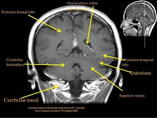 MRI SECTIONAL ANATOMY OF BRAIN