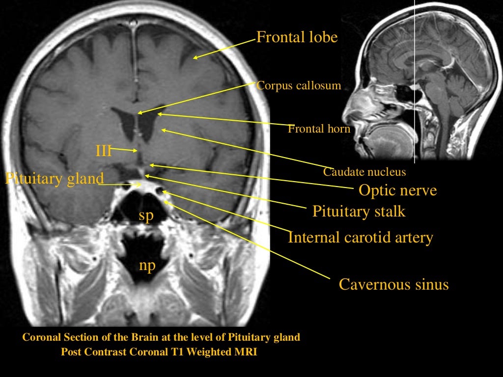 MRI SECTIONAL ANATOMY OF BRAIN