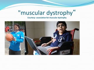 "muscular dystrophy“
Courtesy- association for muscular dystrophy
 