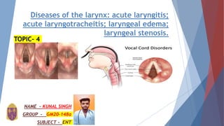 Diseases of the larynx: acute laryngitis;
acute laryngotracheitis; laryngeal edema;
laryngeal stenosis.
NAME – KUNAL SINGH
GROUP - GM20-148a
SUBJECT - ENT
TOPIC- 4
 