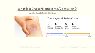 Kung Fu injuries: pathophysiology and Dit Da Jow remedy | PDF