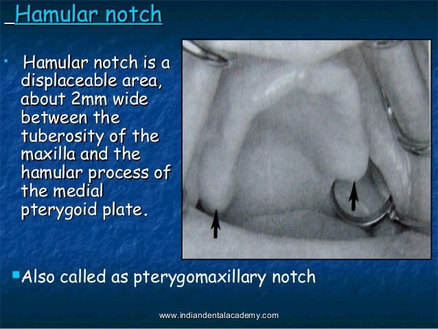biological consideration for maxillary denture bearing hamular notch