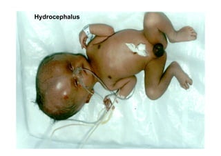 Spatial analysis and risk factors of human toxoplasmosis at special province of Yogyakarta trought ecohealth approaches