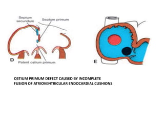 OSTIUM PRIMUM DEFECT CAUSED BY INCOMPLETE
FUSION OF ATRIOVENTRICULAR ENDOCARDIAL CUSHIONS
 