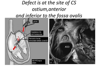 Defect is at the site of CS
ostium,anterior
and inferior to the fossa ovalis
 