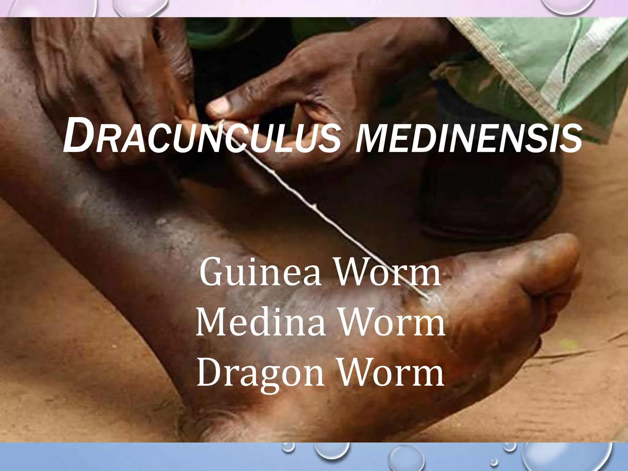 Dracunculus medinensis - Guinea Worm