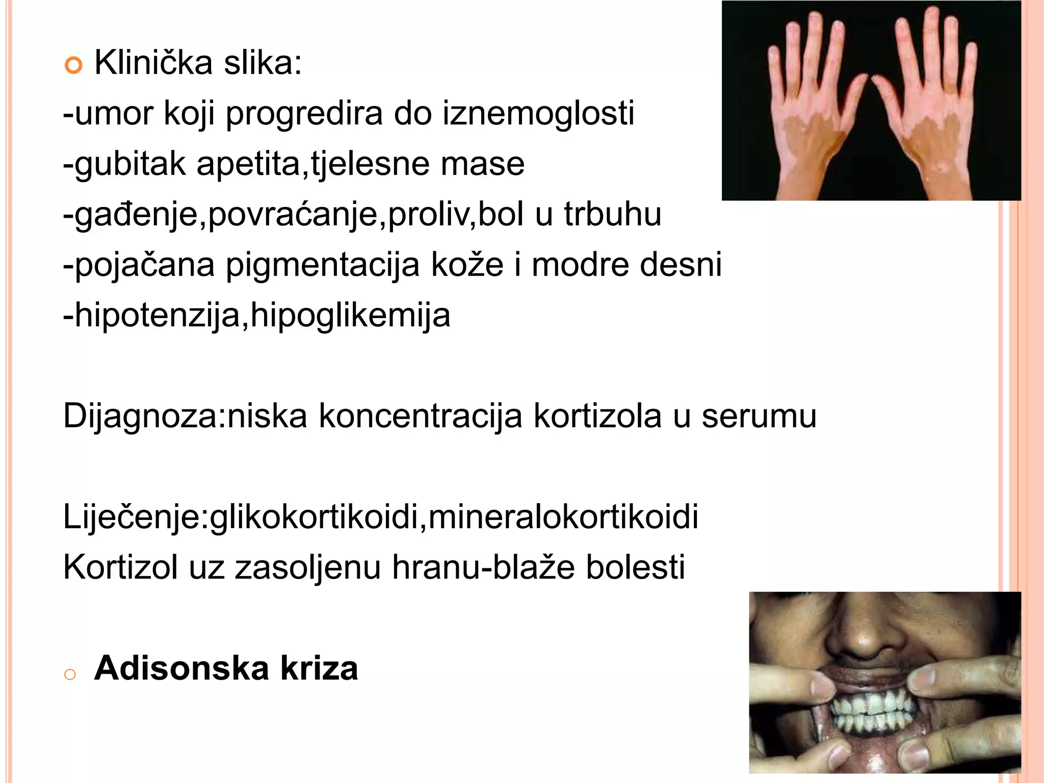 Kušingov sindrom,Adisonova bolest | PPTX