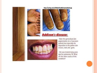 Kušingov sindrom,Adisonova bolest | PPTX