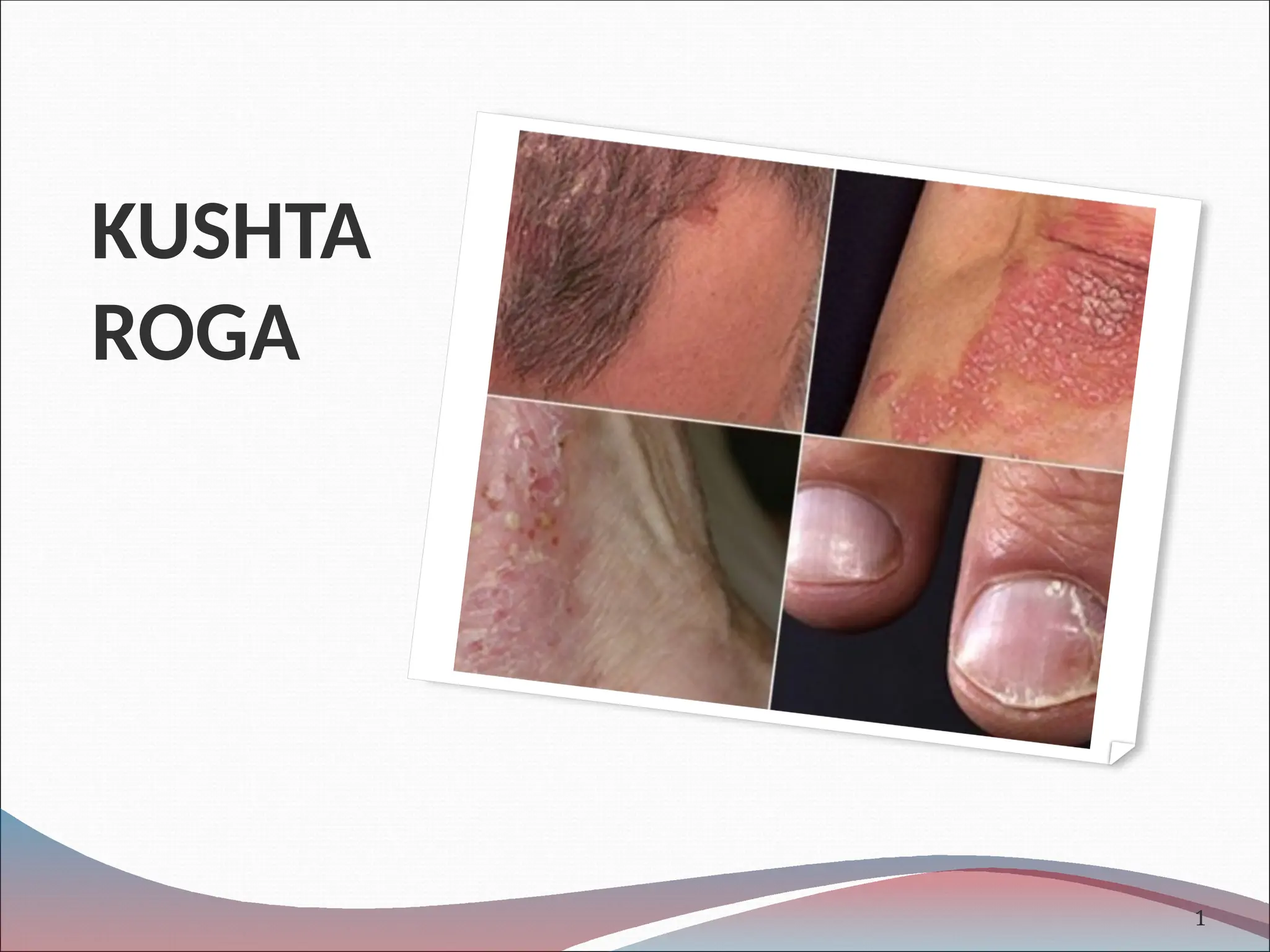 KUSTA.pptx kushta is a skin disorder according to ayurvedic | PPTX