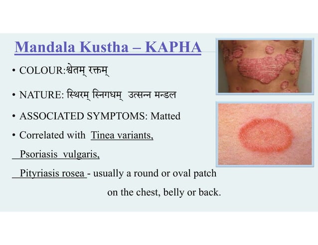 KUSTHA PPT .pdf KUSTHA definition, classification, and modern probable ...
