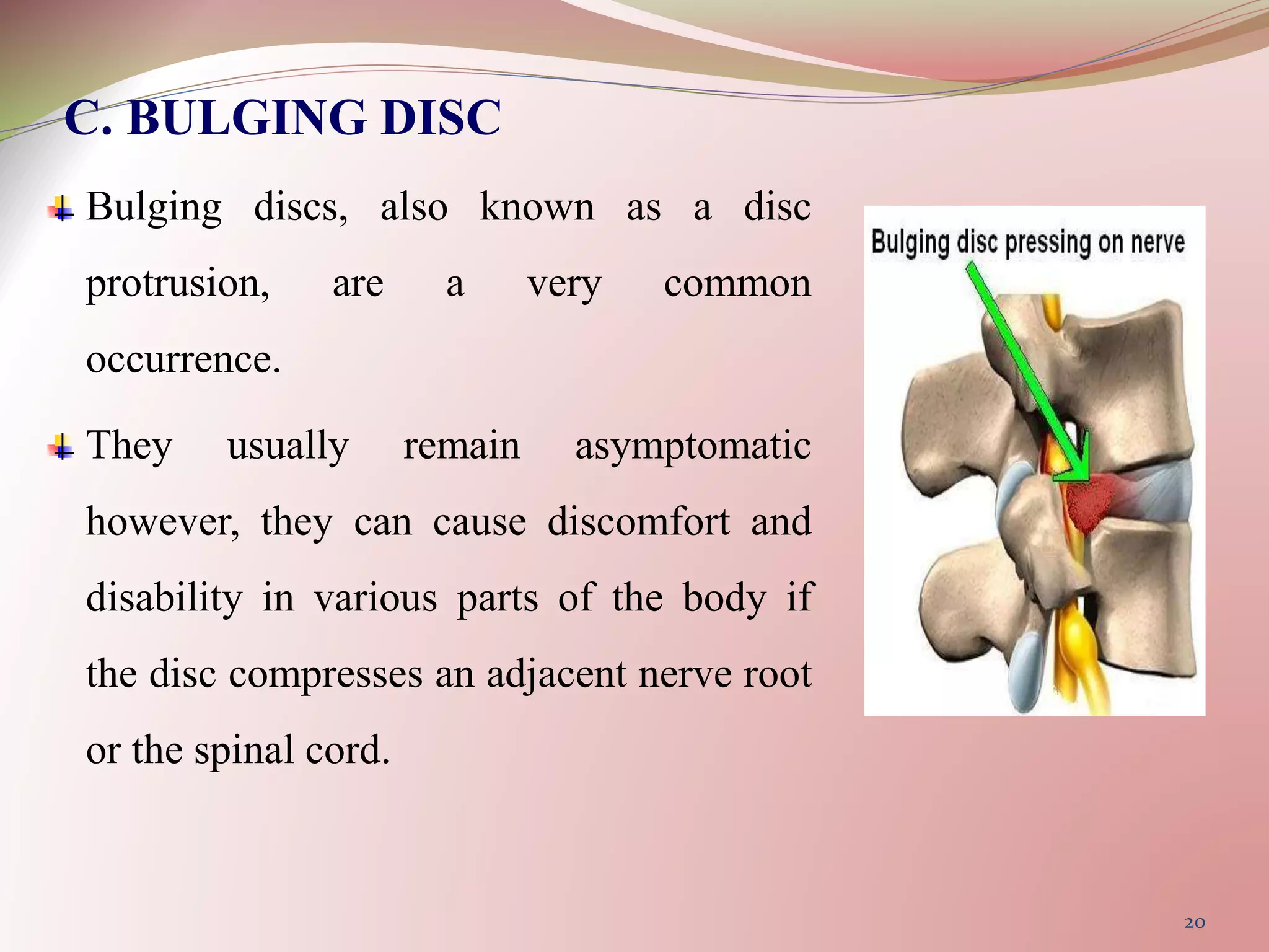 C. BULGING DISC
Bulging discs, also known as a disc
protrusion, are a very common
occurrence.
They usually remain asymptomatic
however, they can cause discomfort and
disability in various parts of the body if
the disc compresses an adjacent nerve root
or the spinal cord.
20
 