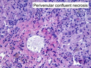 Autoimmune Liver Disease - Kuwait | PPT