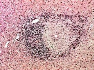 Autoimmune Liver Disease - Kuwait | PPT