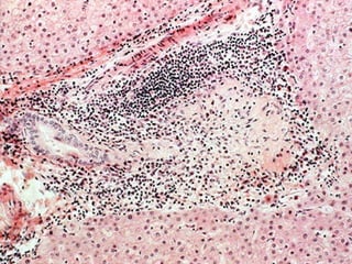 Autoimmune Liver Disease - Kuwait | PPT