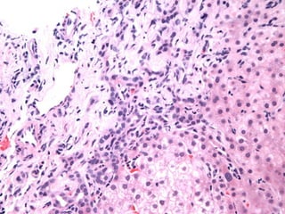 Autoimmune Liver Disease - Kuwait | PPT