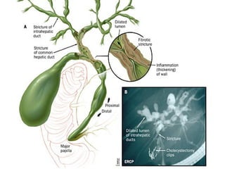 Autoimmune Liver Disease - Kuwait | PPT