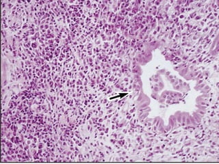 Autoimmune Liver Disease - Kuwait | PPT