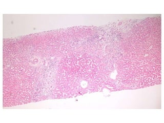 Autoimmune Liver Disease - Kuwait | PPT