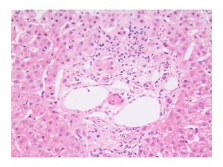 Autoimmune Liver Disease - Kuwait | PPT