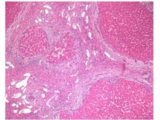 Autoimmune Liver Disease - Kuwait | PPT