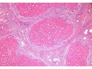 Autoimmune Liver Disease - Kuwait | PPT
