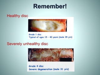 Remember!
Healthy disc
Severely unhealthy disc
 