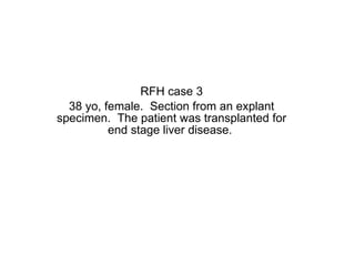RFH case 3 38 yo, female.  Section from an explant specimen.  The patient was transplanted for end stage liver disease.  