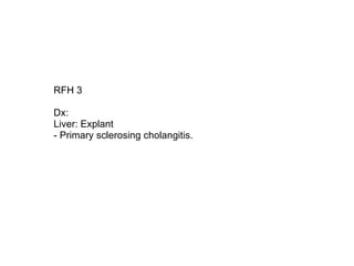 RFH 3  Dx: Liver: Explant - Primary sclerosing cholangitis. 