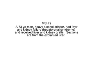 MSH 2 A 73 yo man, heavy alcohol drinker, had liver and kidney failure (hepatorenal syndrome)  and received liver and kidney grafts.  Sections are from the explanted liver.  