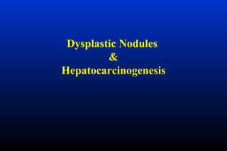 Dysplastic Nodules  & Hepatocarcinogenesis 