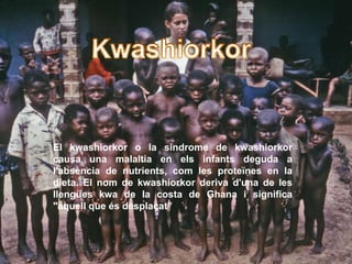Kwashiorkor El kwashiorkor o la síndrome de kwashiorkor causa una malaltia en elsinfantsdeguda a l&apos;absència de nutrients, com les proteïnes en la dieta. El nom de kwashiorkor deriva d&apos;una de les llengüeskwa de la costa de Ghana i significa &quot;aquell que ésdesplaçat” 
