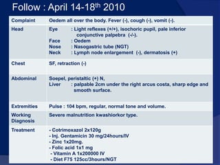 TreatmentDiet F75 125 cc/3 hours/oral.Zinc 1x20mg.Folic acid 1x1 mgMultivitamin without Ferum 1x1Vitamin A 200000 IU 