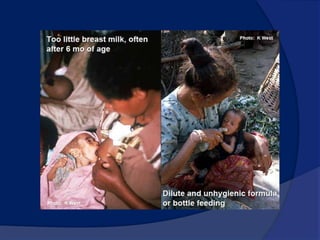 CausesSocial and EconomicPovertyIgnoranceInadequate weaning practicesChild abuseCultural and social practicesVeganLow fat diets